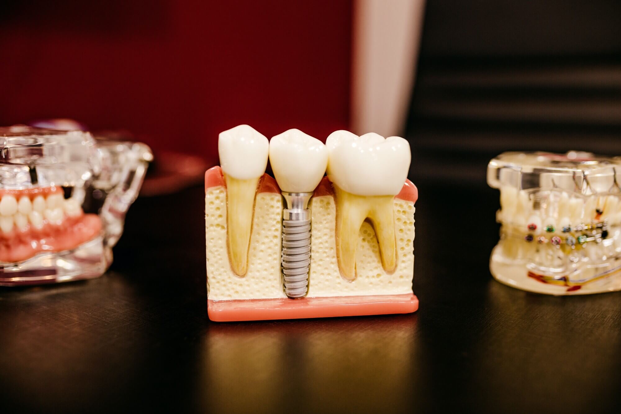 How to Choose a Dental Implant Specialist for Your Needs Garden