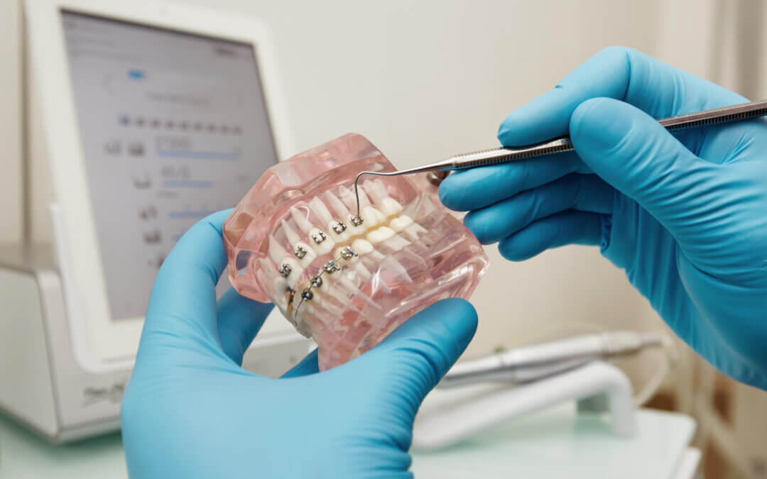 Partial Dentures for Front Teeth: A Guide for Dental Patients in Lexington, KY