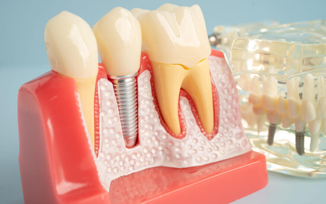 Transform Your Smile With Dental Implants in Lexington