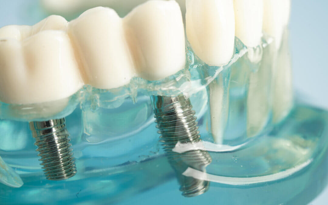 do dental implants hurt