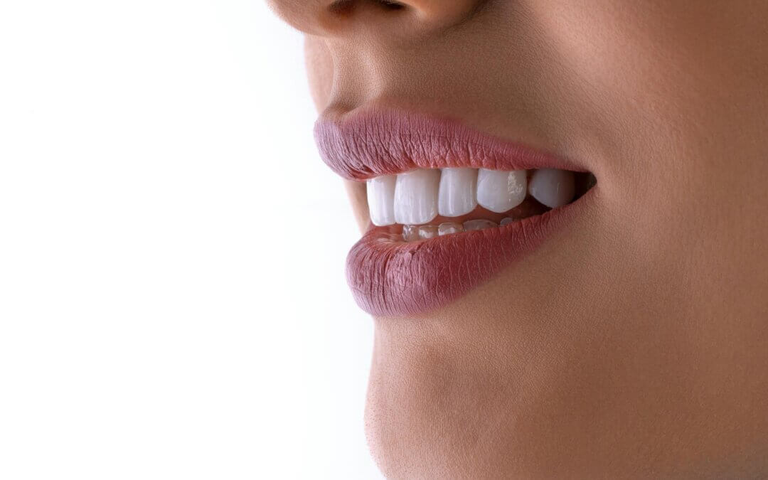 full mouth dental implants